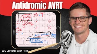 Antidromic AV Reentry Tachycardia AVRT EKG  ECG Lecture [upl. by Corsetti186]