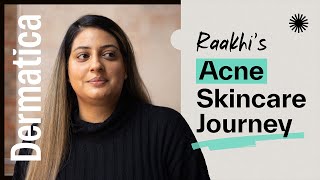 My Dermatica Acne Skincare Journey  Raakhi [upl. by Sparhawk]