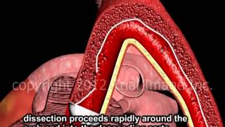 Aortic Dissection  Thoracic amp Abdominal  Animation by Cal Shipley MD [upl. by Paugh]