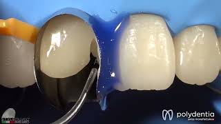 Anterior direct composite restoration performed by Dr Manauta with Unica anterior matrix [upl. by Ailuy]