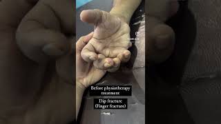 Finger fracture physiotherapy result at allied clinic mehsana [upl. by Suhploda]