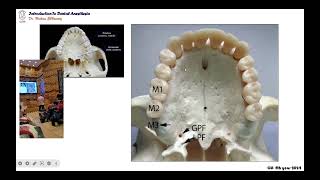 02 maxillary palatal infiltration anesthetic technique [upl. by Jori]