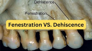 Difference between fenestration and dehiscence with mnemonic [upl. by Radmilla195]