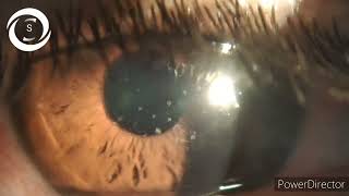 Adenoviral punctate keratitis [upl. by Dolley70]