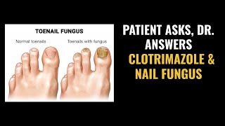 Is Clotrimazole The Best Treatment for Nail Fungus [upl. by Kumar25]