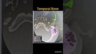 CT temporal Bone anatomy mastoid temporalbone [upl. by Latrena]