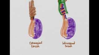 Testicular Torsion [upl. by Kenaz]