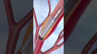 coronary angioplasty and stent insertion 3danimationsurgery anatomy medicalanimation viralvideo [upl. by Ariaic]