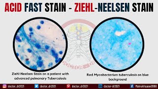 Acid Fast Stain Technique  ZiehlNeelsen Stain  Microbiology Laboratory Techniques [upl. by Rosemary321]