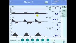 Pressure Regulated Volume Control Mode of Ventilation PRVC A dual mode [upl. by Calv684]