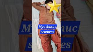 Myoclonic seizures  Myoclonus  SSPE  Epilepsy pediatrics neurology doctor [upl. by Ylagam156]