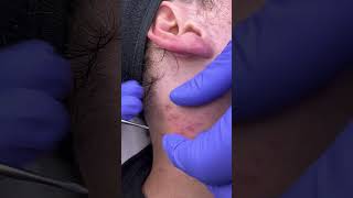 Neck extractions with the Preston Comedone Rxtractor®️ [upl. by Hartmann]