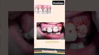 Avulsion management for permanent teeth [upl. by Adle]