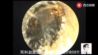 Ear endoscope cleaning the external auditory canal and answering common questions [upl. by Ydassac]