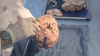 Orientation The Planes of the Brain Neuroanatomy Video Lab  Brain Dissections [upl. by Rabaj63]