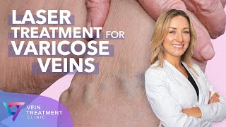 Medical Center Laser Treatment for Varicose Veins  Spider and Varicose Vein Treatment Center [upl. by Enowtna451]