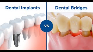 Which is better a dental bridge or implant [upl. by Ahswat]