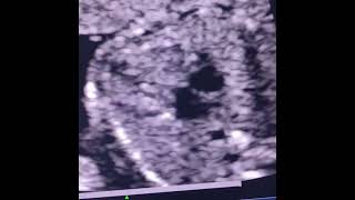 fetal echo showing hypoplastic tv intact septum suggestive of pulmonary atresia intact ivschd [upl. by Majka407]