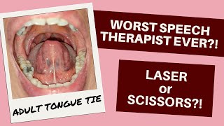 I didnt know I needed SPEECH THERAPY  Adult TONGUE TIE vlog part 1 [upl. by Esihcoc218]