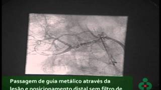 Angioplastia de Artéria Renal [upl. by Frere16]