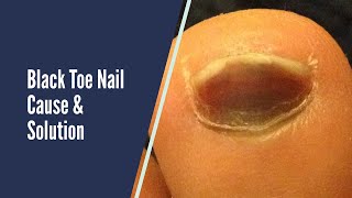 BLACK TOE NAILS  CAUSES AND SOLUTIONS [upl. by Okemak]