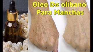 Manchas Na Pele  Benefícios Do Oleo De olíbano Para Manchas Na Pele [upl. by Ellenyl870]