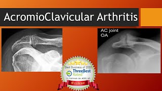 Acromioclavicular Arthritis [upl. by Caswell]