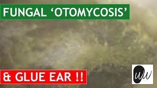 MOST CHALLENGING Otomycosis Fungal Ear Infection Removal from Ear with Glue Ear  370 [upl. by Eah]