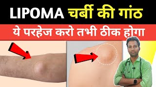 lipoma me parhej  लिपोमा में क्या नहीं खाना चाहिए  Lipoma treatment  Dr tarun [upl. by Aenehs]