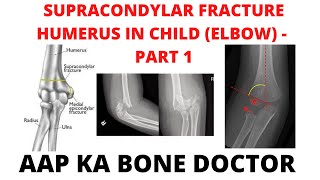 SUPRACONDYLAR FRACTURE HUMERUS IN A CHILD ELBOW  PART 1 EPISODE 27 [upl. by Adniuqal]