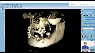 Romexis cbct Dental Implant planning tutorial [upl. by Yehudit13]