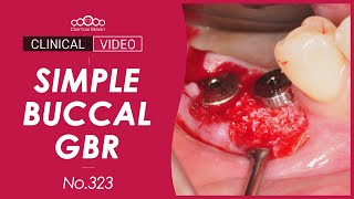 Simple Buccal GBR with Collagen Membrane Dr Kim Jaeyoon [upl. by Malvia]