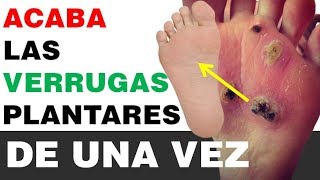 👣 Como Eliminar Verrugas En La Planta Del Pie Ojo De Pescado O Verruga Plantar [upl. by Mandal]