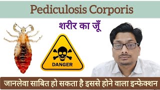 शरीर का जूँ  Body Lice  जानलेवा साबित हो सकता है इससे होने वाला इन्फेक्शन  Pediculosis Corporis [upl. by Nellie590]