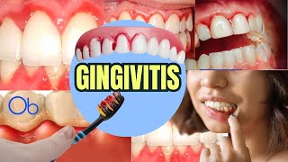 GINGIVITIS qué es síntomas y tratamiento [upl. by Blancha]