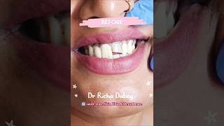 Single crown placementdental crown dentalclinic shortfeed dentalcrown oraismilezone trending [upl. by Reemas41]