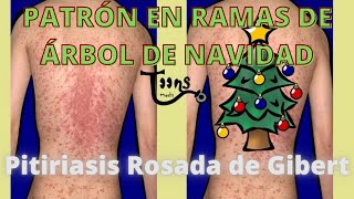 PATRÓN EN RAMAS DE ÁRBOL DE NAVIDADPitiriasis Rosada de Gibert DermatologiaENARM [upl. by Conyers]