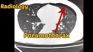 Pneumothorax  CT Scan  Radiology [upl. by Jo]