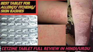 BEST TABLET FOR ALLERGY AND SKIN RASHES AND ITCHINGCETZINE TABLET FULL REVIEW IN HINDIURDU [upl. by Elimac]