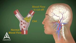 Stroke  3D Medical Animation [upl. by Hurlbut]