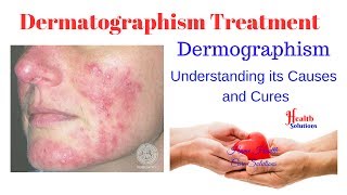 Dermatographism Treatment  Dermographism  Understanding its Causes and Cures [upl. by Yruama]