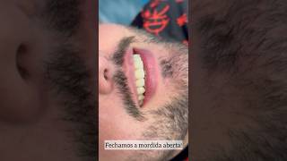 Fechando mordida aberta anterior com facetas em resina composta Resultado natural sorrisolindo [upl. by Sillig352]