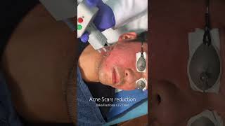 Acne Scars treatment with Deka Fractional Co2 Laser at Wellbeing Clinic in Al Wasl road Dubai UAE [upl. by Henghold731]