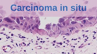 What is Carcinoma in situ  Pathology mini tutorial [upl. by Eelirak]