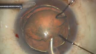 Zonular dialysis in traumatic cataract capsular hook CTR and IOL implant [upl. by Hewe]