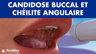 CANDIDOSE buccal muguet et chéilite angulaire  Champignon dans la bouche © [upl. by Read]