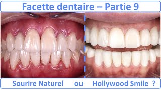 Facette dentaire  Hollywood Smile ou Sourire Naturel   Guide complet  partie 9 [upl. by Ark442]