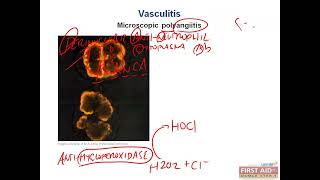 VasculitisWegner Granulomatosis Microscopic polyangiitisHenochscholein Purpura pathology part 10 [upl. by Noxin]