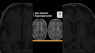 Non Ketotic HyperglycemiaT1Hyperintensity in basal ganglia [upl. by Eednim]