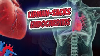 Libman–Sacks endocarditis  Human Heart and Cardiology ❤️❤️❤️🔊✅ [upl. by Yadsendew965]